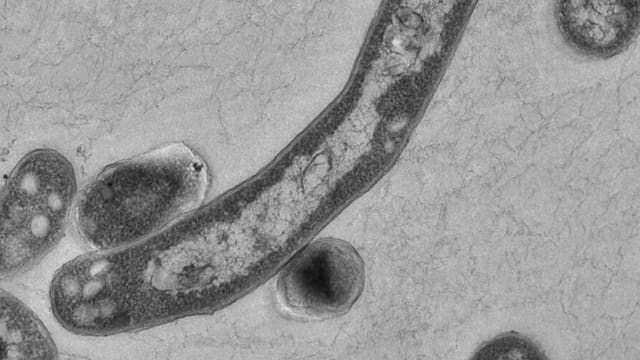 Tuberkulose – die vergessene Pandemie