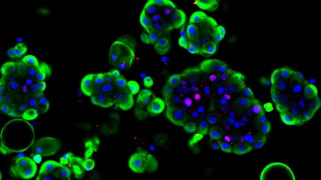  Mit einem Tumor-Avatar gezielter gegen Blasenkrebs