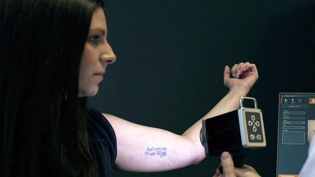  Drei Tipps für eine erfolgreiche Tattoo-Entfernung mit Laser